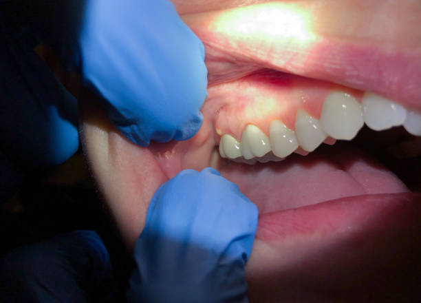 Best Emergency Dental Extractions in Grantville, GA